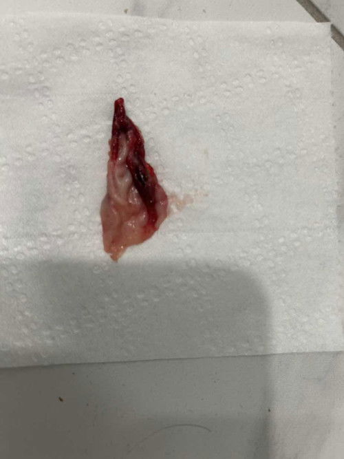 ฉีดยาคุมตอน2เดือนแต่มีประจำเดือนหลังคลอดครบ3เดือน