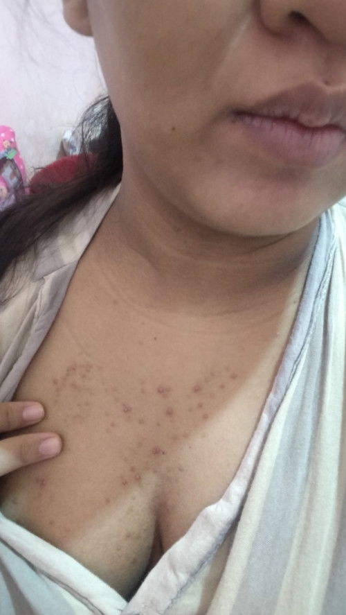 Gatal yang katanya bawaan bayi