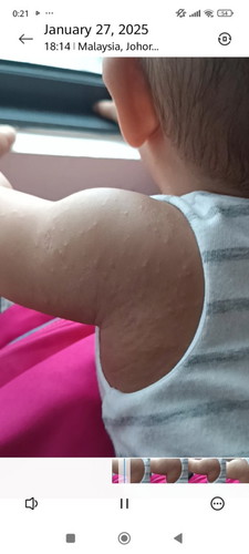 Rashes from armpit
