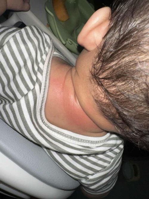 Heat rash or?
