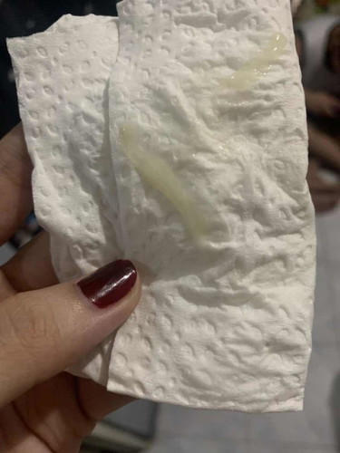 Normal discharge?