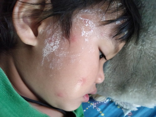 มันคืออะไรคะขึ้นบนหน้าลูก
