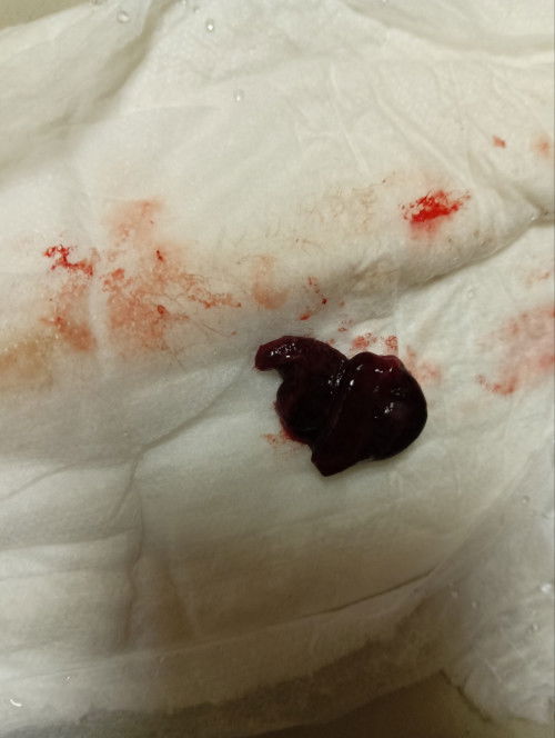 Period atau keguguran?