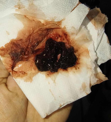 Bleeding at 6weeks na may kasamang blood cloth