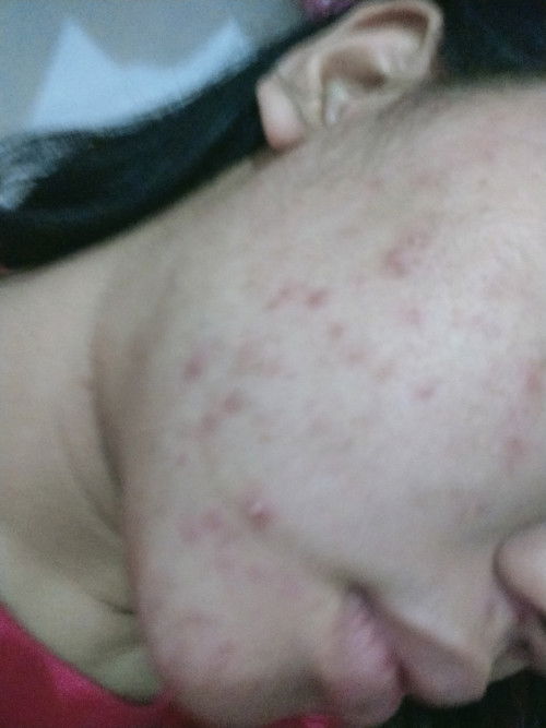 Plss help any recommend for acne