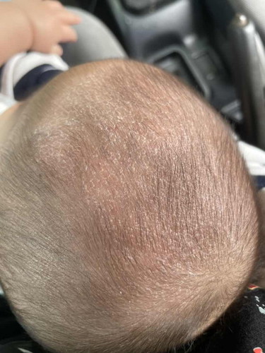 kepala baby 4bulan macam mengelupas