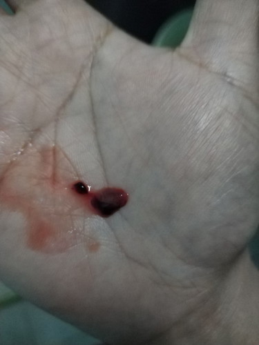 Askum nk tnye prgnt 10 minggu
Dan bleeding dah 3 hari, keluar gumpal mcm ht ayam,bole jd kgguran ke?