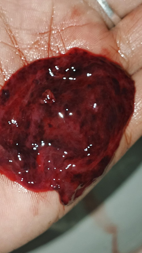 Delay Ako Ng 5 weeks may faint line Sa PT ko na 3 test, tas nag bleed Ako ,may lumabas sakin ito