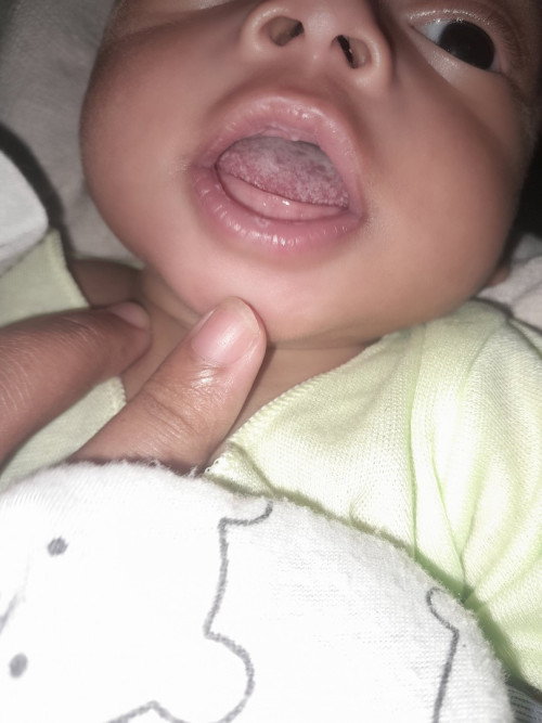 Lidah bayi putih susah hilang
