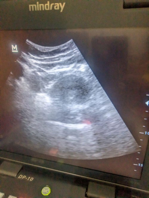 Apakah aman dok,saya tidak haid udah 3 bulan setiap di tp -
Trus waktu USG kata bidan 2x saya USG