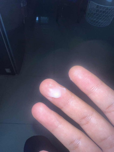 Keputihan berwarna putih susu