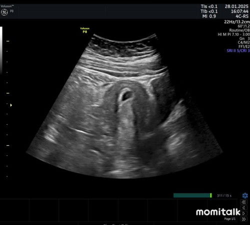 8 week ternyata pas usg 5 week