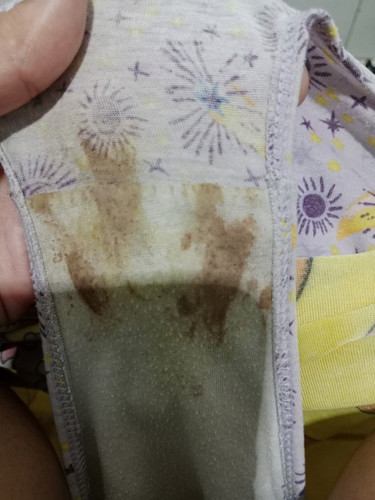 Brown discharge