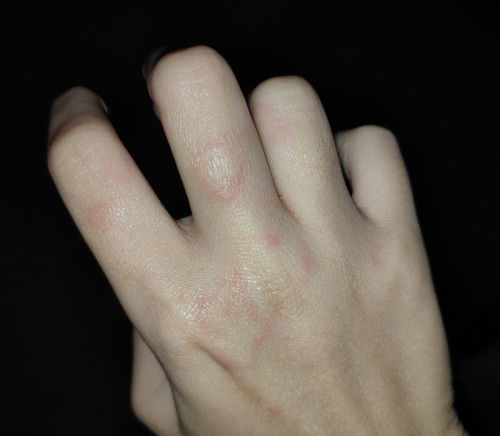 Siapa lagi ada allergic kulit kena brgntung dkt pil tahan allergic & sapi ubat cream steroid?