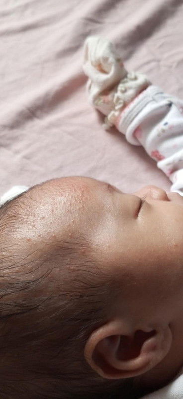 Baby Acne/Baby care