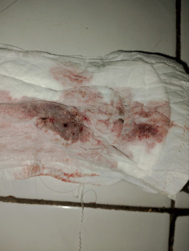 Apakah ini flek tanda kehamilan???