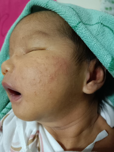 ผื่นขึ้นหน้าลูก