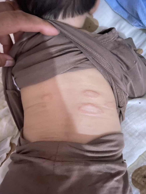 อันนี้คือผื่นอะไรรคะแม่