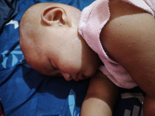 Ruam merah setelah demam tinggi mereda