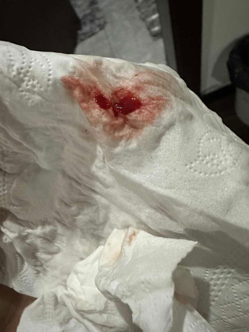 Nosebleed im 17weeks