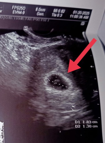 normal lang po ba na no embryo? 6wks and 1 day npo me nung nag pa check up sa ob ko.monday po FU ko.