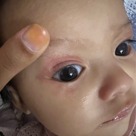 Kelopak mata baby merah