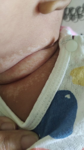 Saya nk tnya..kalau bwh leher baby jd tompok2 putih mcm ni kenapa ye? Bukan ruam..baby 2 bulan.
