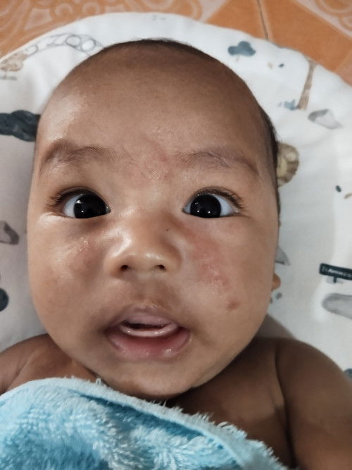 หน้าน้องขึ้นผื่น