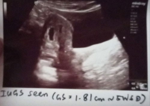 Ultrasound scan at 5w6d.