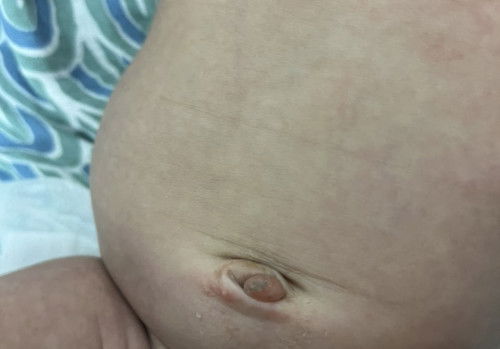 ADA YANG PERNAH TERKENA GRANULOMA