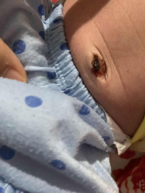 Rốn em bé 18 ngày