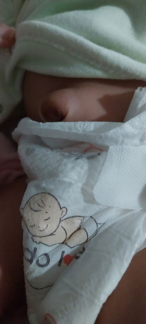 สะดือแบบนี้จะยุบไหมคะ ใครเคยเป็นบ้าง