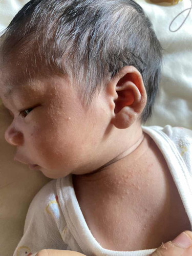 สอบถามค่ะ น้อง24วัน ถ่ายสีเขียวมีมูก ตามตัวมีผื่นขึ้นปกติไหมคะ น้องทานนมแม่ล้วนค่ะ