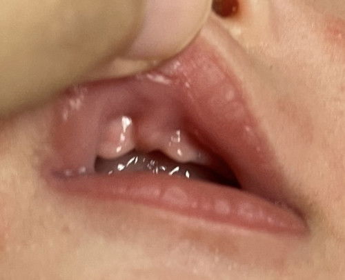 bentuk gusi terbelah