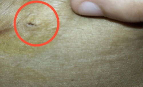 Luka pasca SC 8bulan