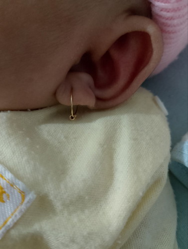 Maaf ada yg bisa kasih saran. Apakah ada solusi buat bayi 2 bulan yg telinga nya melipat sedikit.