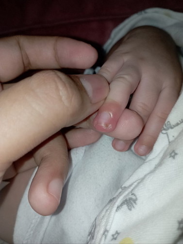 Namamaga na daliri ni baby