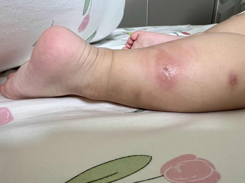 Insect bite