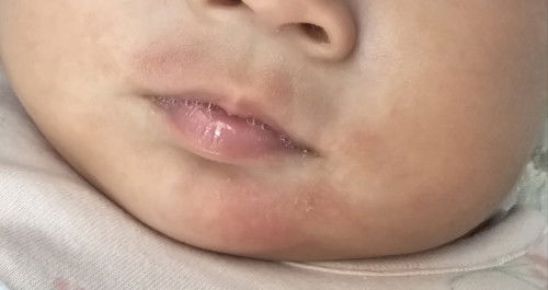 Red bumps around chin and mouth