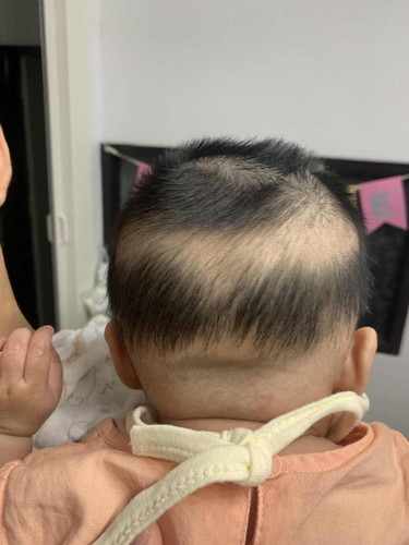 ผ้าอ้อมกัดหัว หรือแพ้อะไร