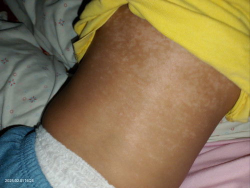 Bekas merah merah di badan