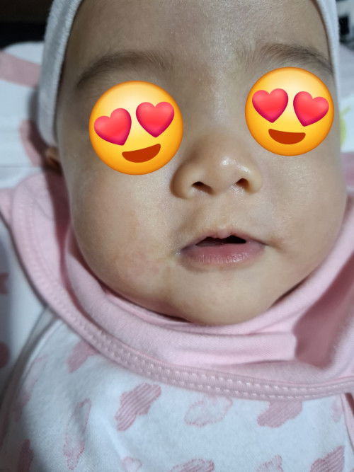 Skin rash on cheeks of my 4 mos old baby