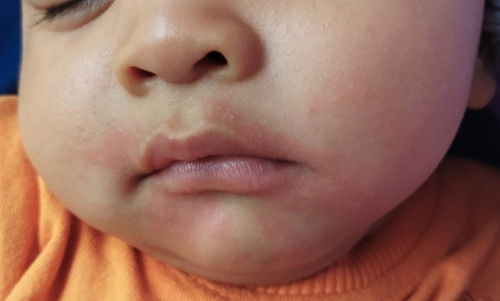 Ruam di sekitar mulut timbul setelah makan, kenapa ya Bun? Kalo udah beberapa jam ilang sih.