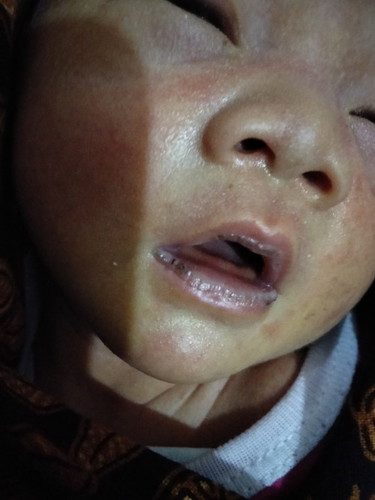 ada putih putih di bibir bayi