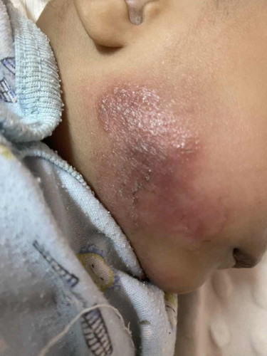 Ruam susu atau eczema ?