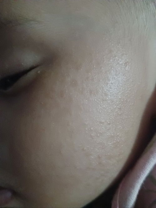 Cara menghilangkan bintik-bintik diwajah bayi