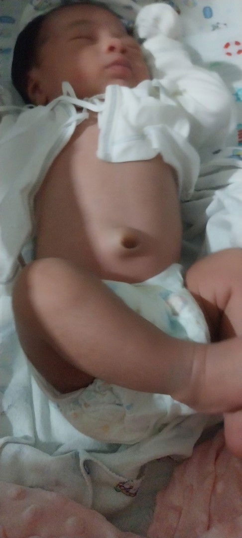 สะดือจุ่นอันตรายไหม