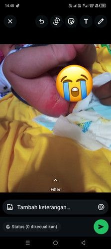 babynya ruam popok sampai mengelupas gini dikasih obat apa ya biar sembuh tolongg sarannya dong bun