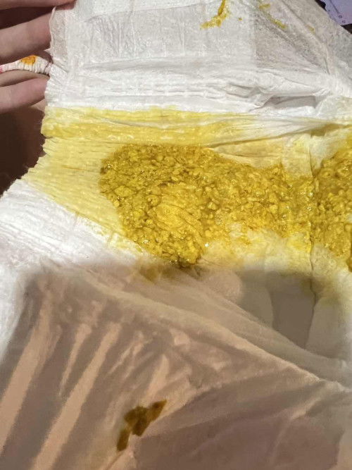 ทารก5เดือนกินนมผงถ่ายแบบนี้เรียกว่าท้องเสียมั้ยคะน้องถ่ายมา6รอบแล้ว ไม่มีกลิ่นเหม็นค่ะ