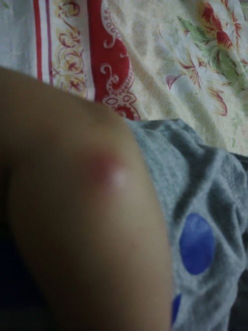 Benjolan di tangan dekat siku